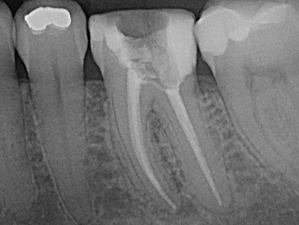 Wurzelkanalbehandlung